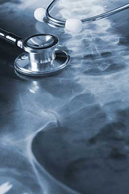 Spinal Cord Injuries in Arlington, TX